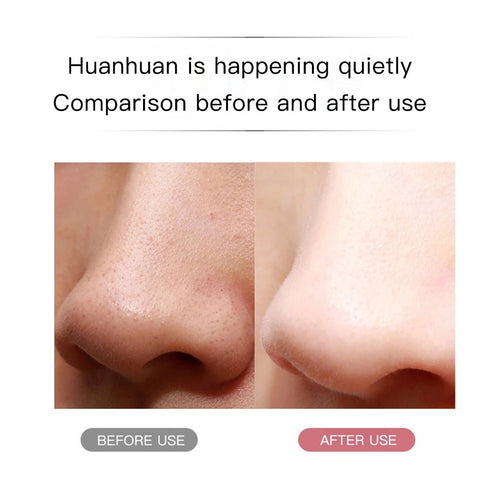 Ultrasonic Skin Scrubber — Blackhead Remover & Deep Pore Cleaner Face Tool